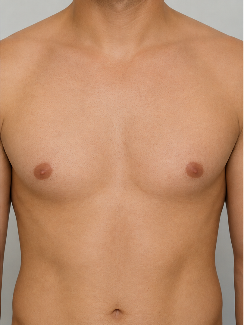 After laser hair removal