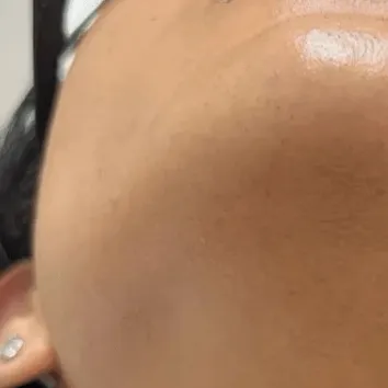 Skin after treatment